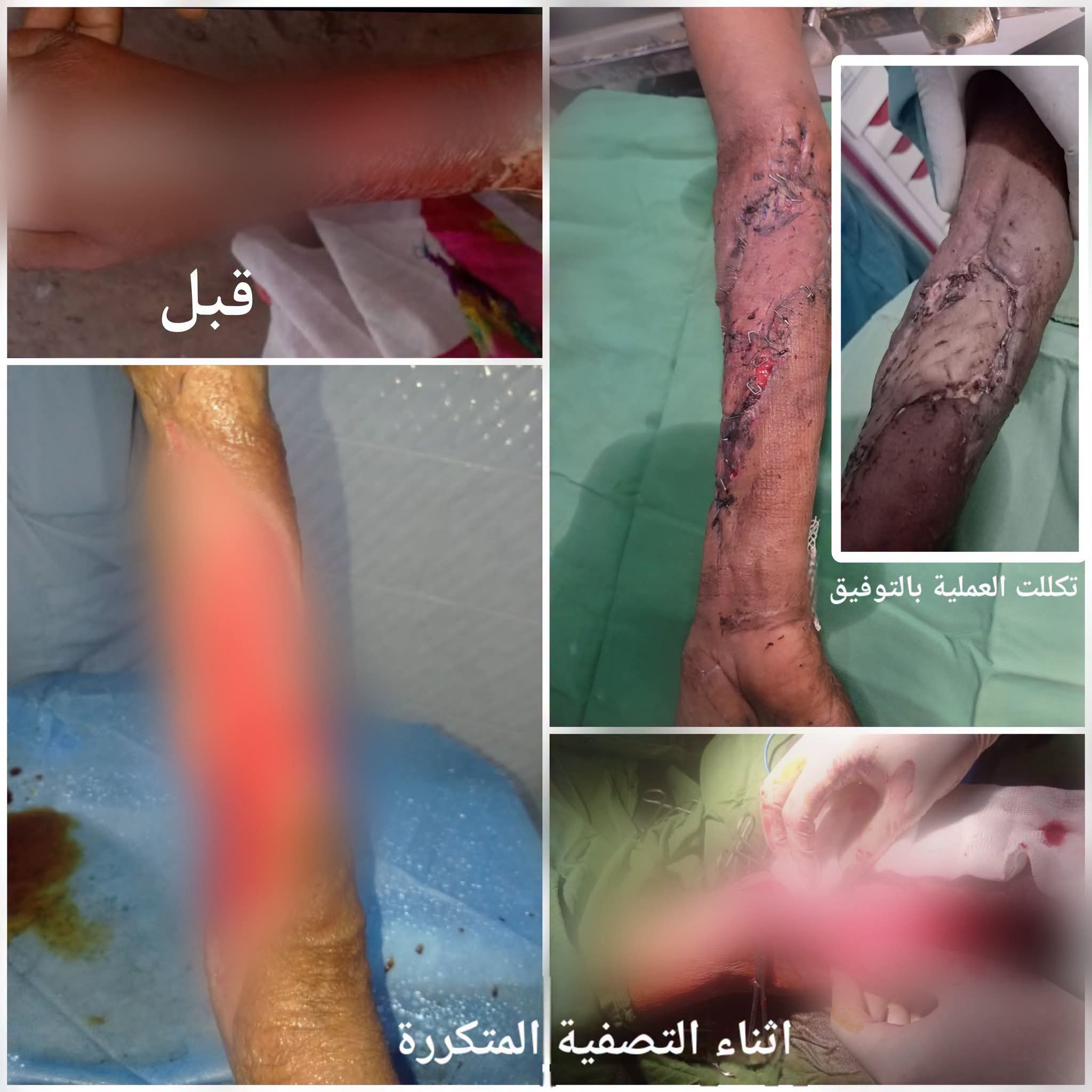 مستشفى حيس ينجح في إنقاذ مريضة بعملية جراحية إثر إصابتها بعدوى فتاكة
